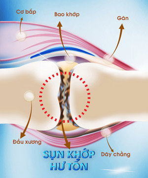 ĐAU NHỨC KHỚP, MỐI NGUY TÀN PHẾ